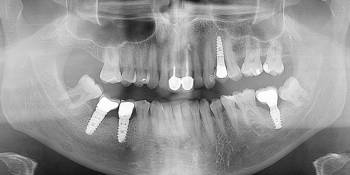 titanium-dental-implant